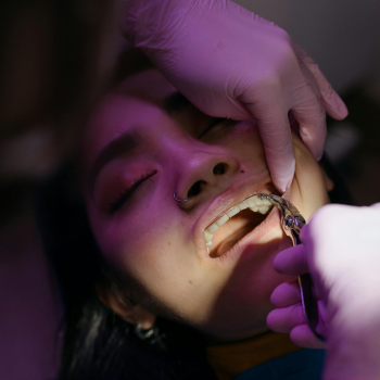 Dental Crowns