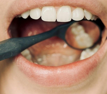 Dental-Sealants