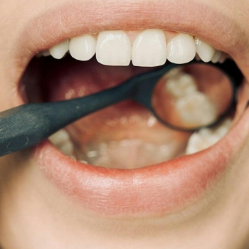 Dental-Sealants